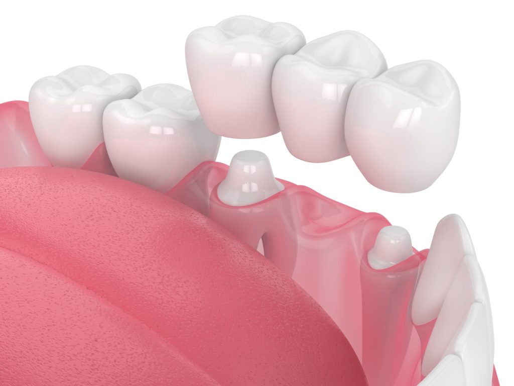 Dental crowns and bridges in Somers, NY - Rosen Dental PC