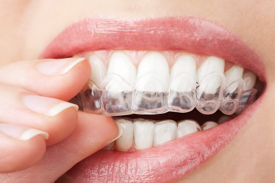 Invisalign Provider