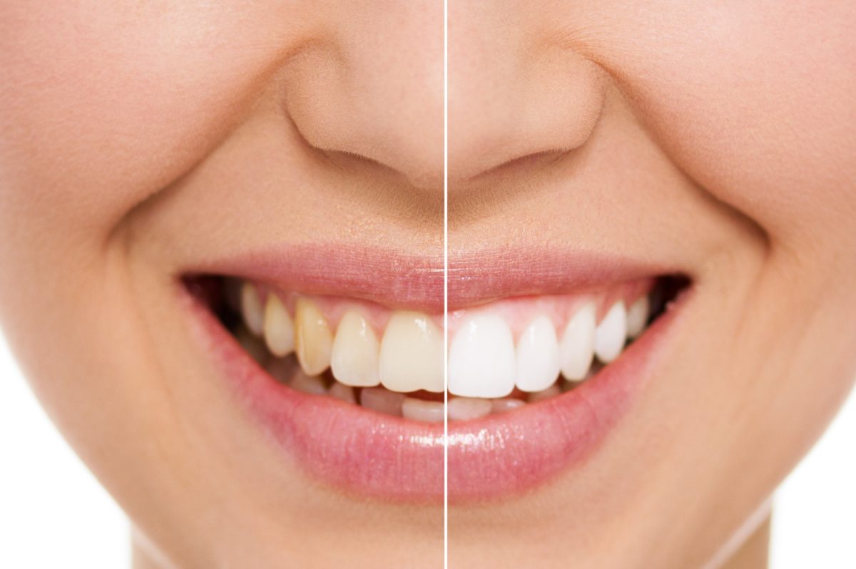 Teeth whitening services in Somers, NY - Rosen Dental PC